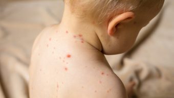 Les Pays de la Loire touchés par une épidémie de varicelle