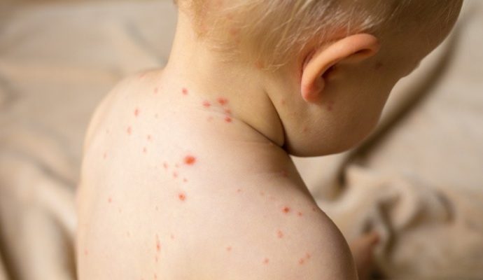 Les Pays de la Loire touchés par une épidémie de varicelle